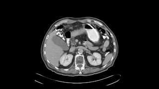 Scirrhous gastric adenocarcinoma signet ring cell type [upl. by Nagyam]