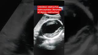 Foramen of Monro obstruction Unilateral hydrocephalus Third and fourth ventricle normal [upl. by Beale]