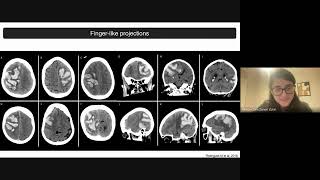 Angiopatia Amiloide Cerebral AVC hCemorrágico e HSA Hemorragia subaracnoidea [upl. by Assek432]