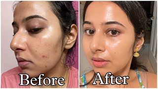 Simple Tretinoin Night Skincare Routine for Acne free Glowing Skin skincare skincareroutine [upl. by Notyalc]