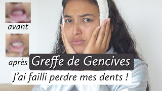 JE ME FAIS OPÉRER DES GENCIVES PARODONTITE GREFFESTORYTIME RÉSULTATJai failli perdre mes dents [upl. by Molli]