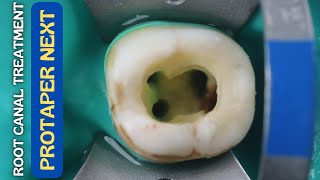 Root Canal Treatment in Mandibular Molar ⚪️ Protaper Next 🔵 Step By Step Demonstration [upl. by Soni446]