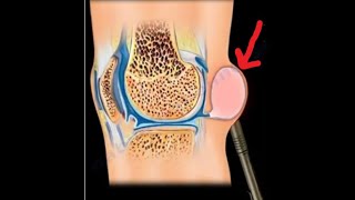 Bakers Cyst its relationship to meniscus tears and knee arthritis [upl. by Zane]