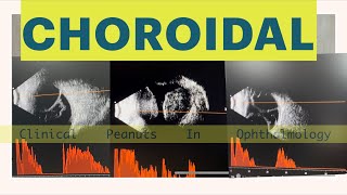 Choroidal Detachment  Haemorrhagic Vs Serous Atlas of B scan [upl. by Castera]