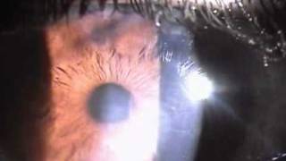 resolving herpetic stromal keratitis [upl. by Norita]