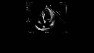 Echocardiography Study [upl. by Fawnia166]