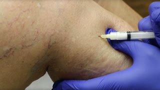 Sclerotherapy Varicose Veins Treatment [upl. by Neros]