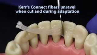 Ribbond compared to other dental fiber reinforcement materials [upl. by Malca]