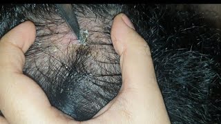 best patch of dandruff scab found so far  satisfying  watch till end  scab pick using knife asmr [upl. by Inamik]