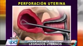 PROCREAR ¿Los legrados uterinos afectan la fertilidad [upl. by Trinidad]