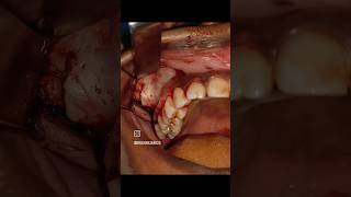 case of infected odontogenic cyst  Surgery  Face surgery  Oral Surgeon surgeon oralsurgeon [upl. by Dixie]