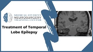 Treatment of Temporal Lobe Epilepsy [upl. by Lucho]