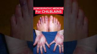 Chilblains treatment homeopathy  homeopathic medicine for chilblains  बीवाई का इलाज [upl. by Bower]