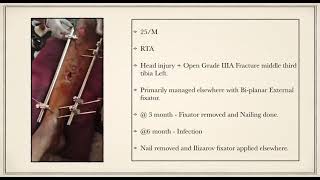 Revision Ilizarov fixation for Open grade IIIA fracture shaft tibia [upl. by Jasen]