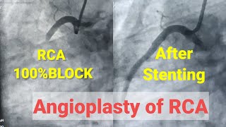 Primary Angioplasty of RCA Stenting of RCA 100 blcoked RCA [upl. by Merrilee719]