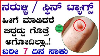 Naruli ge Mane Maddu  Warts Removal Tips  Naruli Treatment in Kannada  shorts warts naruli [upl. by Asiulana]