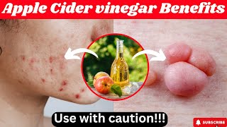 9 Life Changing Benefits Of Apple Cider Vinegar you must know [upl. by Duwad]