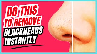 JUST Do THIS to Remove Blackheads From Your Nose [upl. by Kean311]