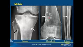 Imaging of Bone Tumors [upl. by Nickelsen]