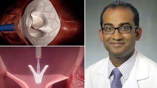 Mitral Valve Clinical Trials Surgeon QampA with Dr Pavan Atluri Penn Medicine [upl. by Aikcir]