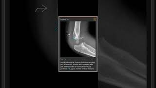 Lateral Condylar Fracture [upl. by Kinna]