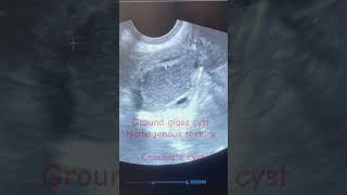 Endometriosis infertilityChochlate ovary cyst treatmenttrendingshorts viralsongendometriosisivf [upl. by Nira]