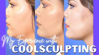 My Experience with CoolSculpting  QampA and Results [upl. by Applegate]