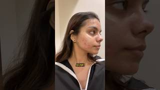 Laser treatment for Acne Scars ‼️ is it worth it Check description for details youtubeshorts [upl. by Calica]