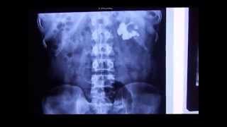 Intravenous Pyelogram  Intravenous Nephrogram  Intravenous Pyelography IVP in Staghorn Calculus [upl. by Eeltrebor]