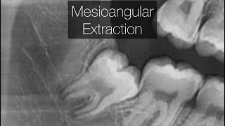 Mesioangular Extraction with Trough Sectioning and Purchase Point [upl. by Haimrej146]