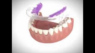 Inman Aligner Introduction Video [upl. by Perkin157]