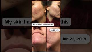 My journey with accutane amp pcos ❤️‍🩹 [upl. by Aynekal939]