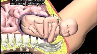 Shoulder Dystocia McRoberts Maneuver Animation by Cal Shipley MD [upl. by Aehsel]