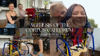 Agenesis of the Corpus Callosum  Physiotherapy Updates [upl. by Obe]