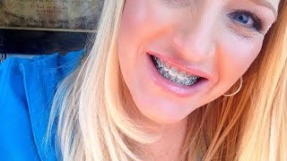 Adult Braces Update Tips and things to buy before your braces go on [upl. by Kamaria]