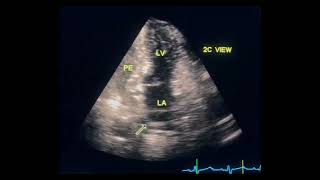 Pericardial effusion and LA collapse to drahmadmirdamadisiC1IXQDQrHgkAYk2Z [upl. by Ahsakal]