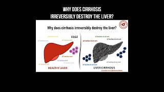 Why does cirrhosis irreversibly destroy the liver cirrhosis liver livercirrhosis liverhealth [upl. by Adnawahs]