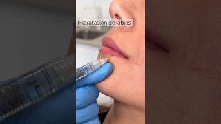 Hidratación de Labios con Ácido Hialurónico [upl. by Ecirehc30]