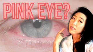 How Do I Know If I Have Pink Eye  Common Causes Of Pink Eyes [upl. by Tavish]