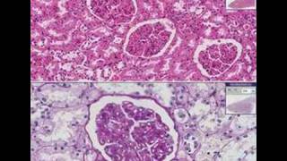 Histopathology KidneyMembranous glomerulonephritis [upl. by Aikam]