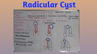 Radicular cyst [upl. by Feingold]