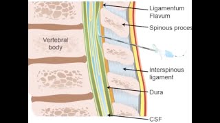 Thoracic epidural anesthesia [upl. by Blossom604]