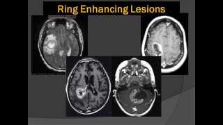 Brain Scans Lord of the Ring Enhancing Lesions 101 [upl. by Eednim]