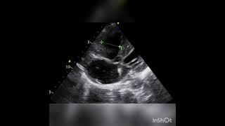 Ventricular septal defect [upl. by Mikal]