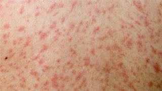 THE PAPULAR RASHES IN MEASLES RUBELLA URTICARIA [upl. by Talbert694]