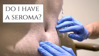 What is a Seroma  Fluid Build Up After Surgery  Symptoms and Treatment  Dr Daniel Barrett [upl. by Nellac]