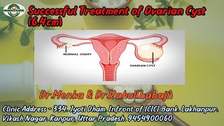 Successful Treatment of Ovarian Cyst 64cm ovariancysts ovary homoeopathy drrahulbabaji [upl. by Gnel]