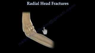 Radial Head Fracture Everything You Need To Know Dr Nabil Ebraheim [upl. by Gusti249]