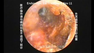 External auditory canal foreign body mixed with cerumen embolism 20241111 [upl. by Rexer46]