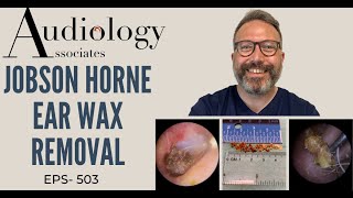 JOBSON HORNE EAR WAX REMOVAL  EP 503 [upl. by Cirre53]